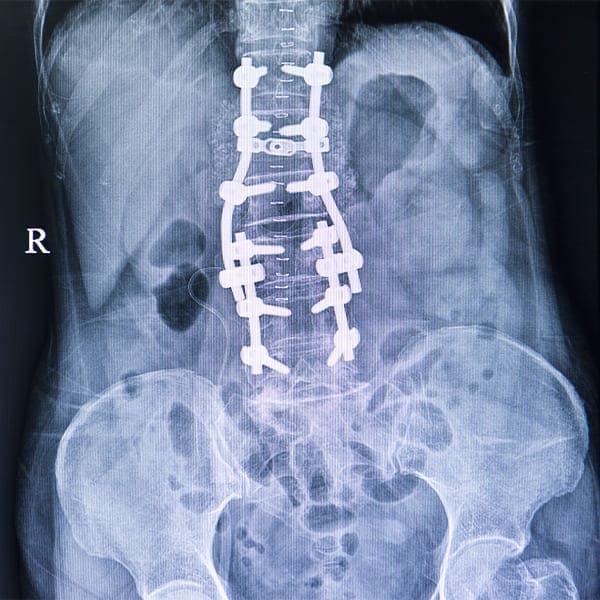 Cifoplastía o vertebroplastia